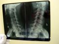 spinal-xray